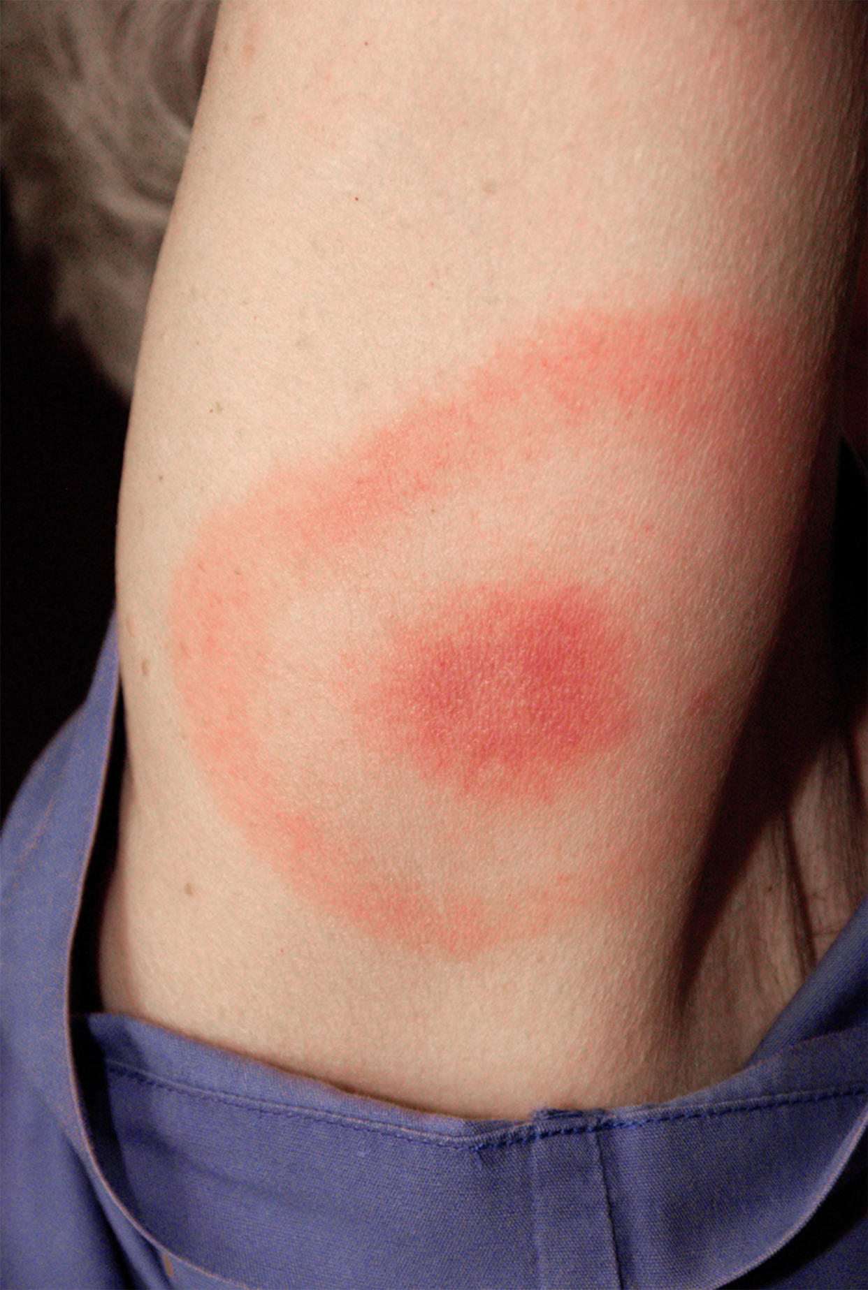 Bull's eye rash (TODAY)