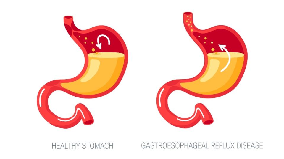 An illustration of GERD