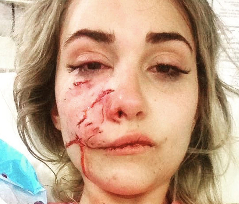 Suzel Mackintosh was attacked by her friend's dog while on a New Years Eve camping trip in Western Australia.