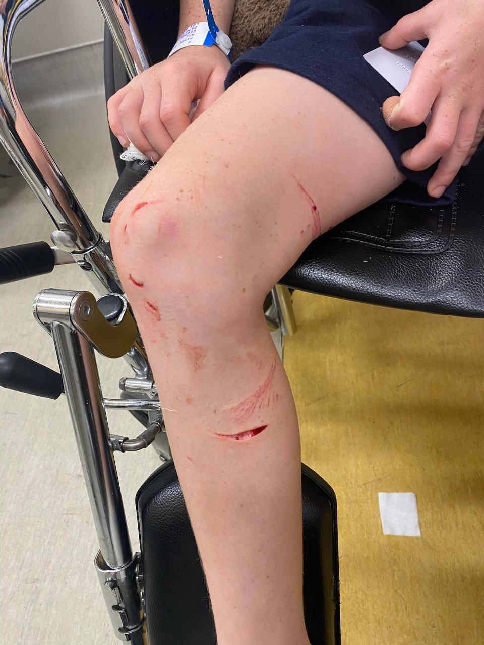 Max Mandl, an eight-year-old visiting Montreal from Los Angeles, emerged from the water at Parc Jean-Drapeau's man-made lake with these injuries. 