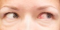 <p>Uveitis is inflammation of the middle layer of the eye that has blood vessels. This red irritation can signify a wealth <a href="https://www.womansday.com/health-fitness/a22487425/yeast-infection-symptoms-in-women/" rel="nofollow noopener" target="_blank" data-ylk="slk:of infections;elm:context_link;itc:0;sec:content-canvas" class="link ">of infections</a> and conditions, such as some sexually transmitted diseases like AIDS. According to <a href="https://www.webmd.com/eye-health/common-eye-problems#1" rel="nofollow noopener" target="_blank" data-ylk="slk:WebMD;elm:context_link;itc:0;sec:content-canvas" class="link ">WebMD</a>, those with AIDS may experience uveitis, as well as blurred vision, eye pain, redness, and light sensitivity.</p>