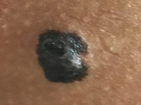 TINEA NIGRA 🔍 This lady had noticed this brown mark growing on her hand  over the previous year. 🍄 #skincancer #melanoma #mole #b