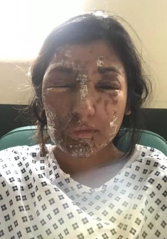 Resham Khan suffered a horrific acid attack in London back in June. Source: GoFundMe