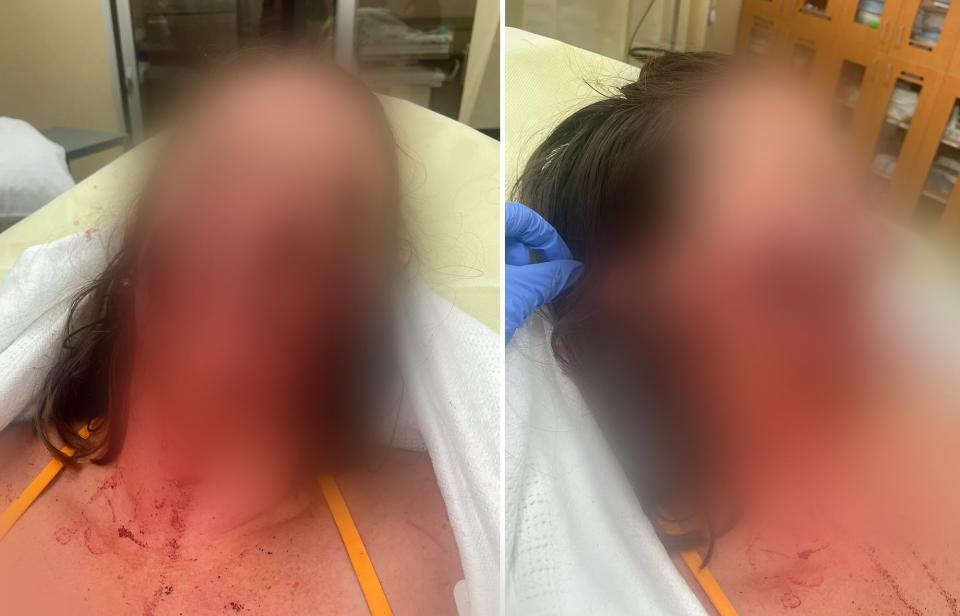 A woman attacked by river otters in a hospital bed, her face blurred.
