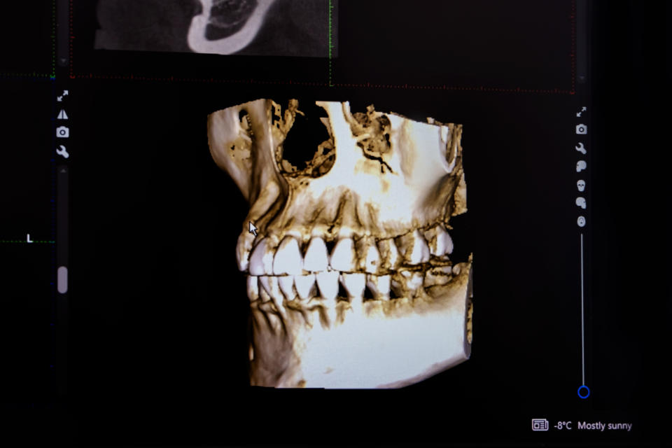 A 3D medical scan of a human skull displayed on a screen. The scan shows the teeth and facial bones in detail. Weather information "8°C Mostly sunny" is visible