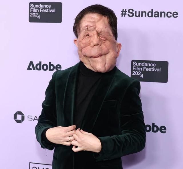 A Different Man Star Adam Pearson Opened Up About The Lazy Way