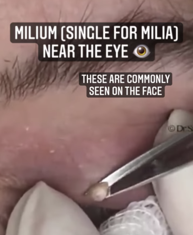 Dr. Pimple Popper Cuts Off A Bead-Sized Milium In A New IG Video