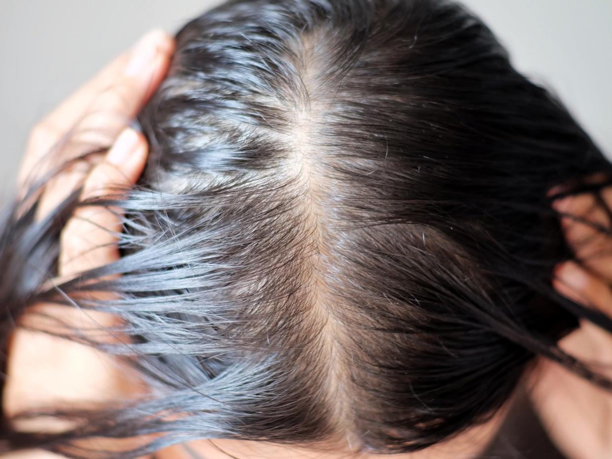 Top down view of a woman’s head with thinning hair along the part.