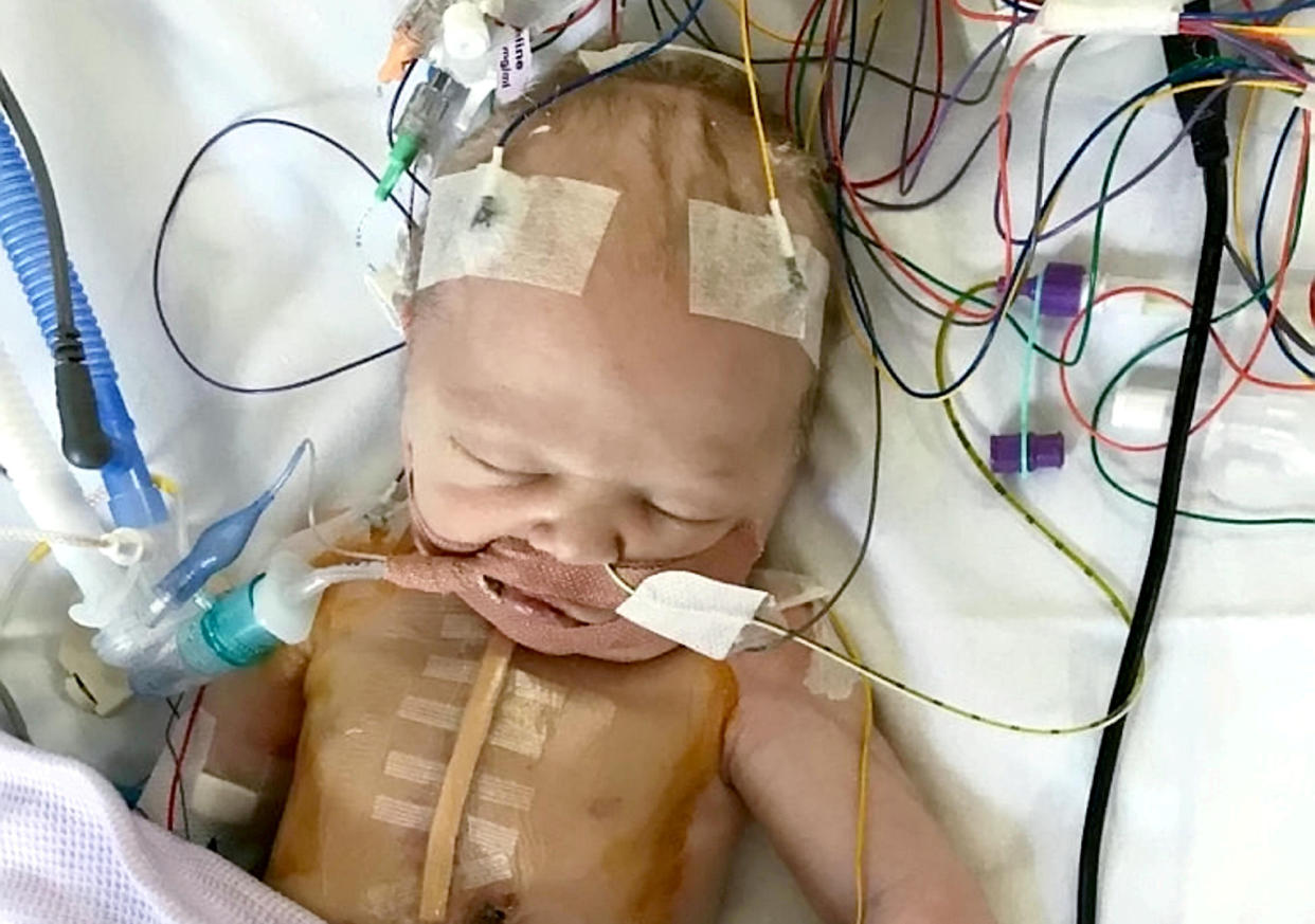 Baby Rory was less than a day old when he had to undergo open heart surgery to save his life. (SWNS)