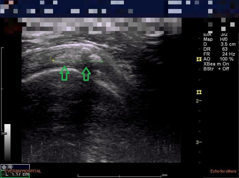 圖為超音波檢查照，箭頭處為鈣化結晶沉積在脊上肌肌腱。(記者徐義雄攝)