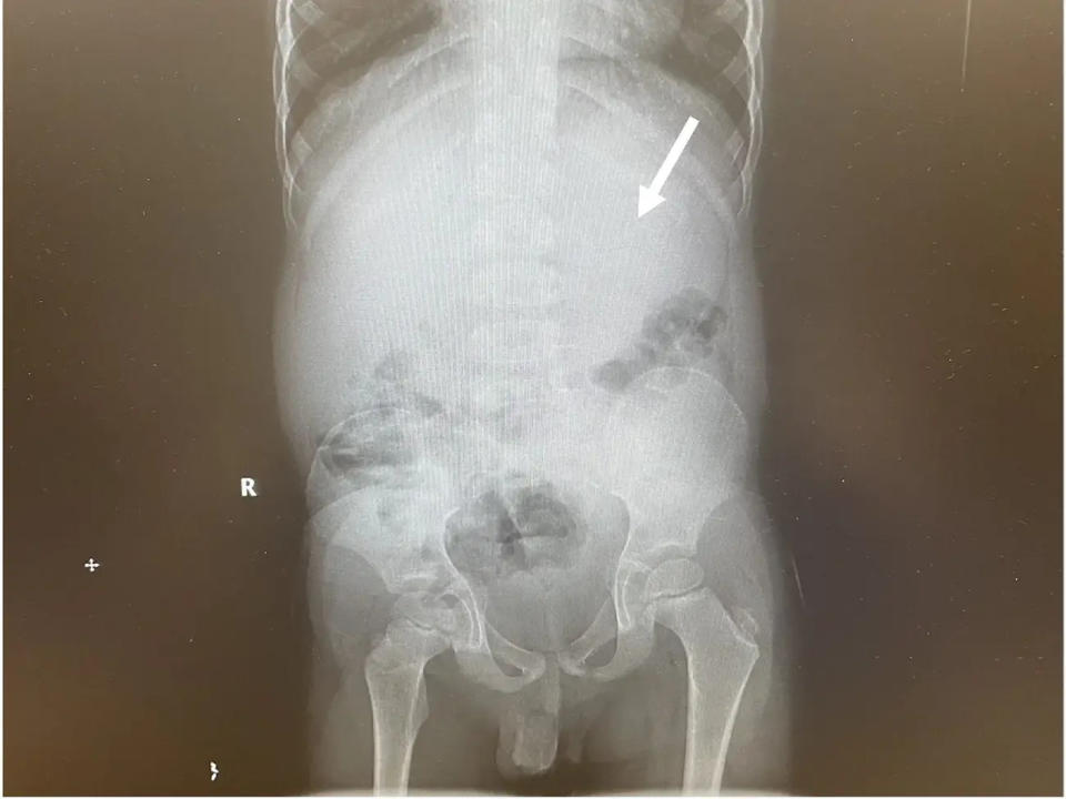 Ein Röntgen-Bild zeigt den Magen eines Fünfjährigen. - Copyright: JEM Reports