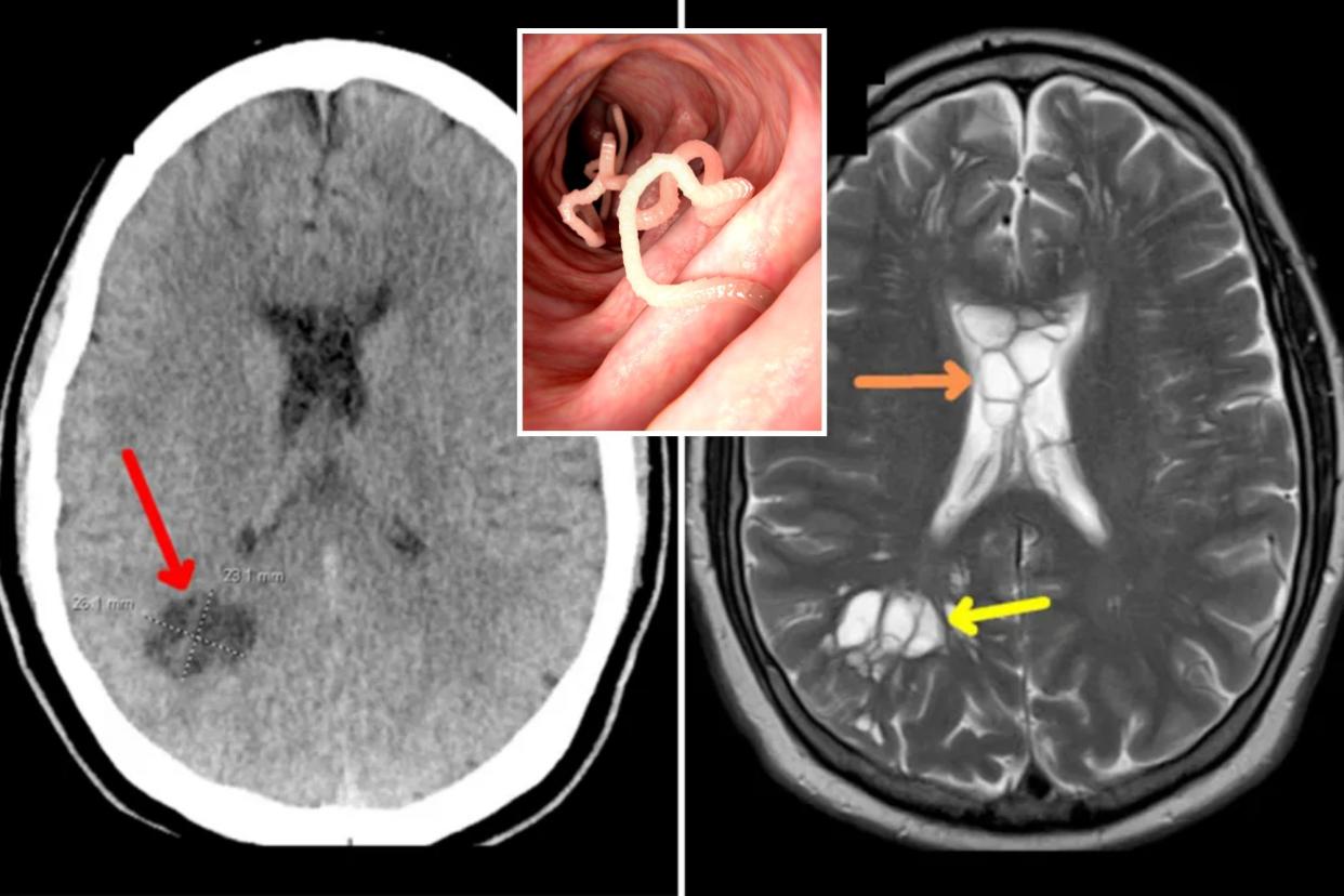 A 52-year-old Florida man thought to be suffering from severe migraines was actually battling a bizarre tapeworm infestation in his brain — caused by eating undercooked bacon.