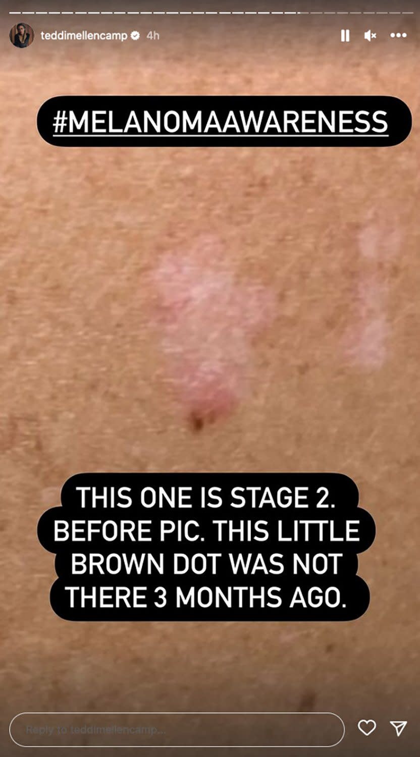 Teddi Mellencamp skin cancer diagnosis https://www.instagram.com/stories/teddimellencamp/2946807631327306448/