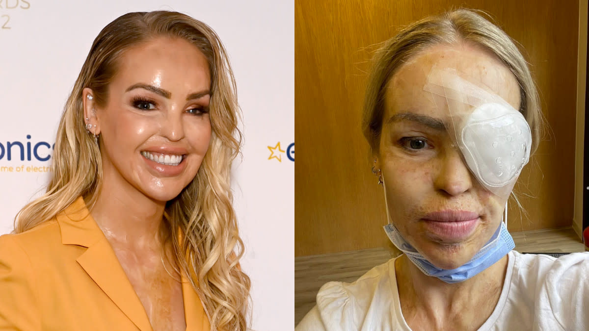 Katie Piper revealed this week that she required emergency surgery to her left eye. (Getty/Instagram/Katie Piper)