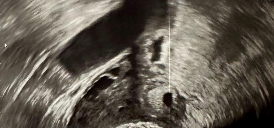 An ultrasound found that Lauren was having an ectopic pregnancy. (SWNS)