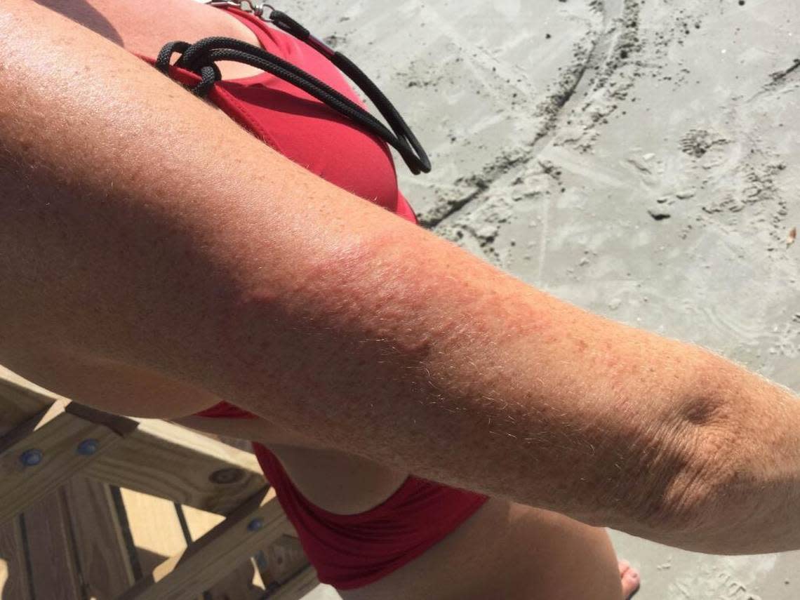 Myshel Rodenbeck, a lifeguard with Shore Beach Services on Hilton Head Island, shows her recent jellyfish sting on Coligny Beach on Aug. 25, 2016 . It’s not the first time she’s been stung, and she said getting stung can help lifeguards be more empathetic when they’re treating beachgoers.