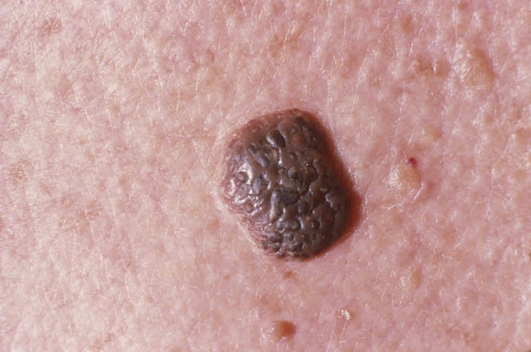 seborrheic keratoses images