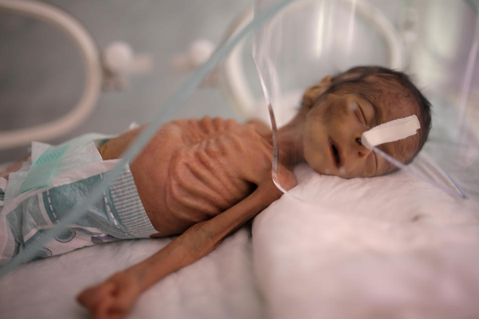 FILE - In this Nov. 23, 2019 file photo, a malnourished newborn baby lies in an incubator at the Al-Sabeen Hospital in Sanaa, Yemen. After a visit to Yemen the World Food Program's executive director, David Beasley, warned that his underfunded organization may be forced seek hundreds of millions of dollars in private donations in a desperate bid to stave off widespread famine in the coming months. Beasley told The Associated Press in an interview Wednesday, March 10, 2021, that conditions in war-wrecked Yemen are “hell.” (AP Photo/Hani Mohammed, File)