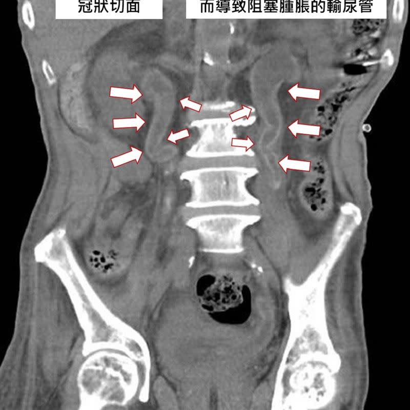 泌尿道結石很常見，結石通常是顆粒狀，竟有人的結石是滿滿覆蓋住泌尿道！（圖／翻攝自衛生福利部彰化醫院）