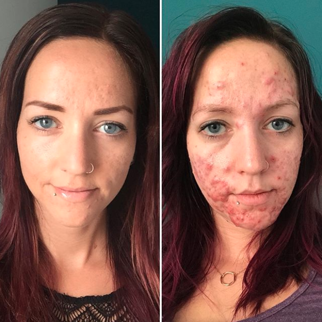 Une femme a partagé plusieurs photos d’elle afin d’illustrer les terribles conséquences de son acné kystique. (Photo : Instagram/stephmkt1d)