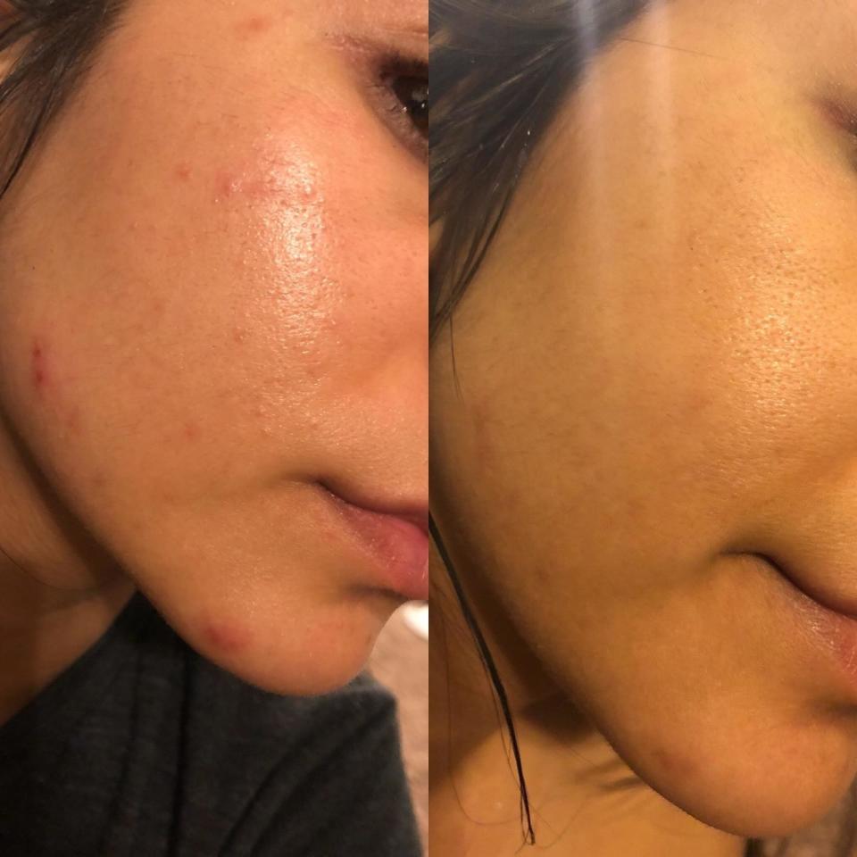 A reviewer's cheeks: before with some bumps and acne and after clear and glowing