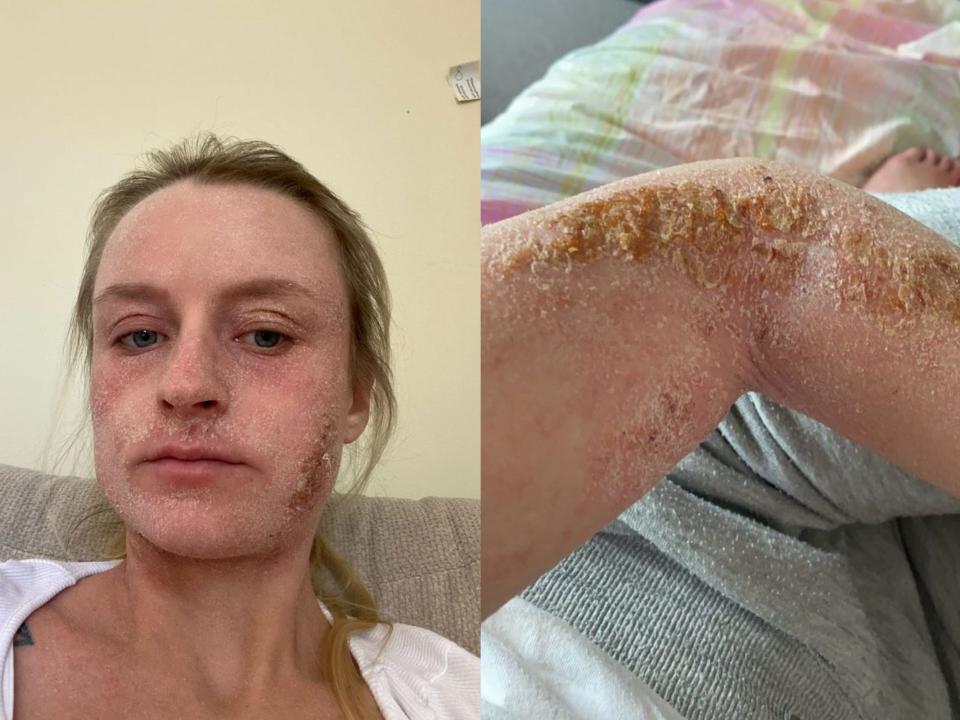 Megan Crome with flakey skin caused by TSW/Her arm scabbed over from weeping wounds.