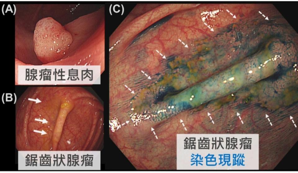 ▲義大大昌醫院研究團隊在大腸鏡發現鋸齒狀腺瘤率高達7%，此研究結果亦榮獲腸胃內視鏡領域的頂尖雜誌《內視鏡》刊登。（義大大昌醫院提供）
