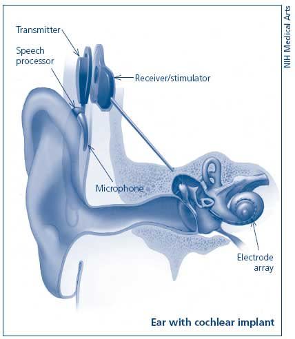 A cochlear implant