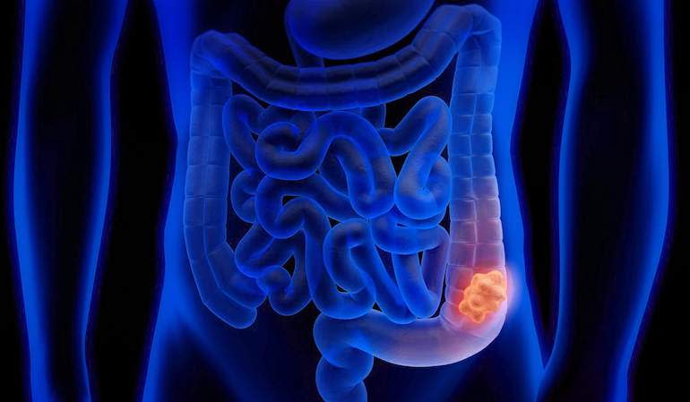  Cáncer de colon: 9 de cada 10 casos son prevenibles