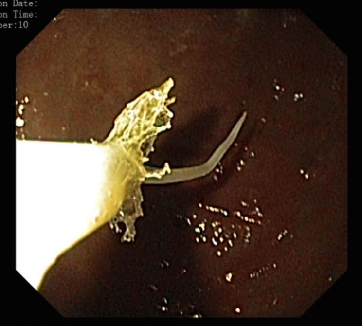 A Roth Net was used to retrieve the worms (BMJ Case Reports) 