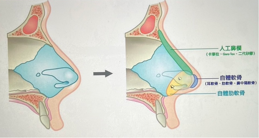 三段功能性隆鼻構造圖
