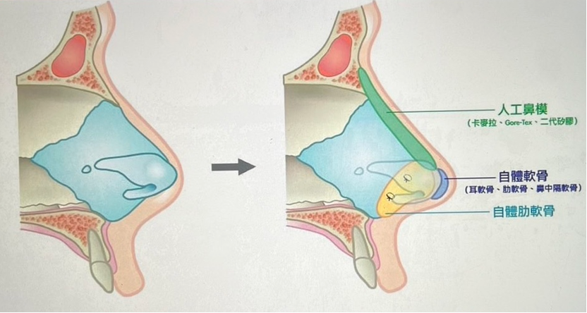 三段功能性結構式隆鼻兼顧功能性與美觀，是隆鼻手術的新趨勢。圖/尚行美健康聯合診所提供