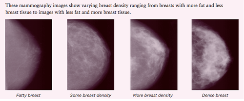 What Does It Mean to Have Dense Breast Tissue? 