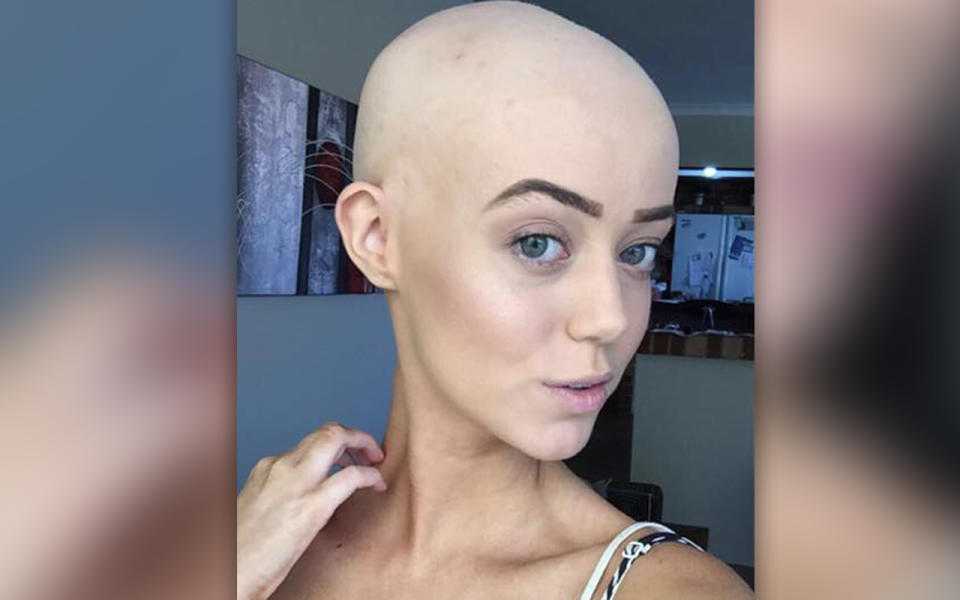 Perth model Lara Kitchen was diagnosed with alopecia at just 14 years old. 