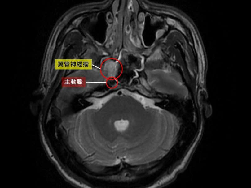 影像檢查發現張先生的翼管神經瘤緊鄰動脈，必須一點一點剝除腫瘤，避免大出血。（圖／台中慈濟醫院提供）