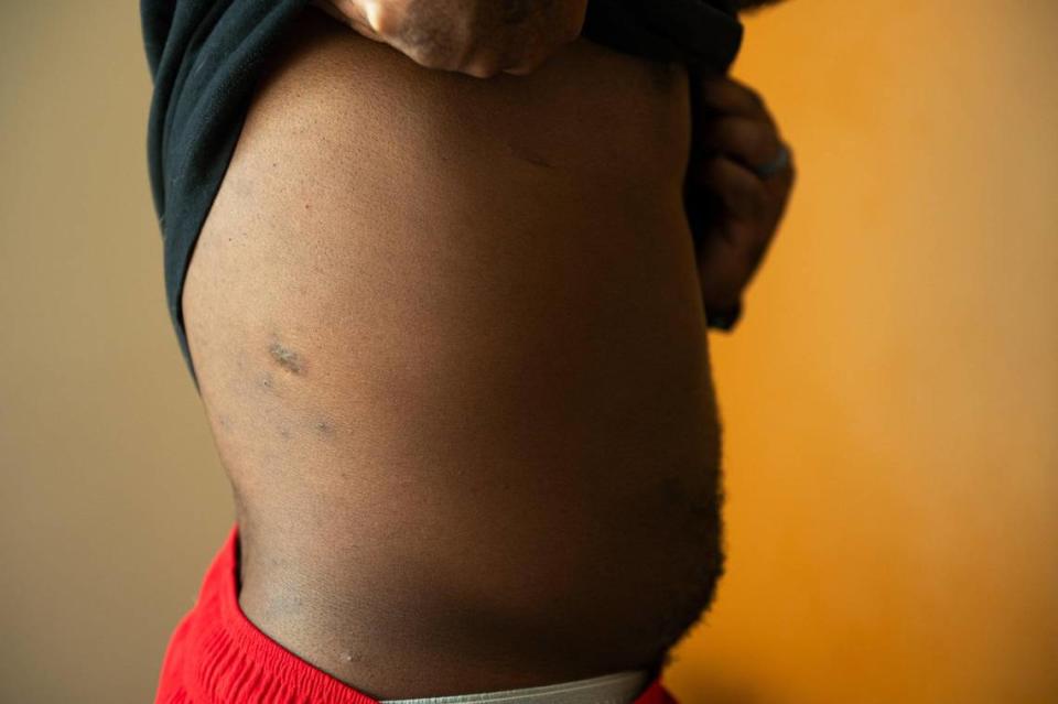 John Roddy lifts his shirt to show his bullet wounds at his home in Blue Springs. Zachary Linhares/The Kansas City Star