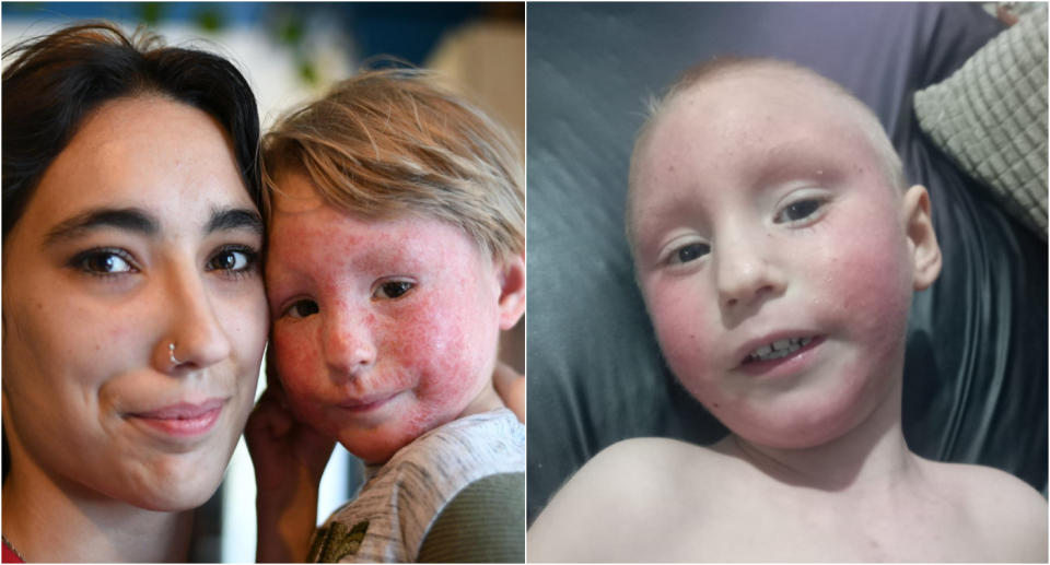 child with severe eczema