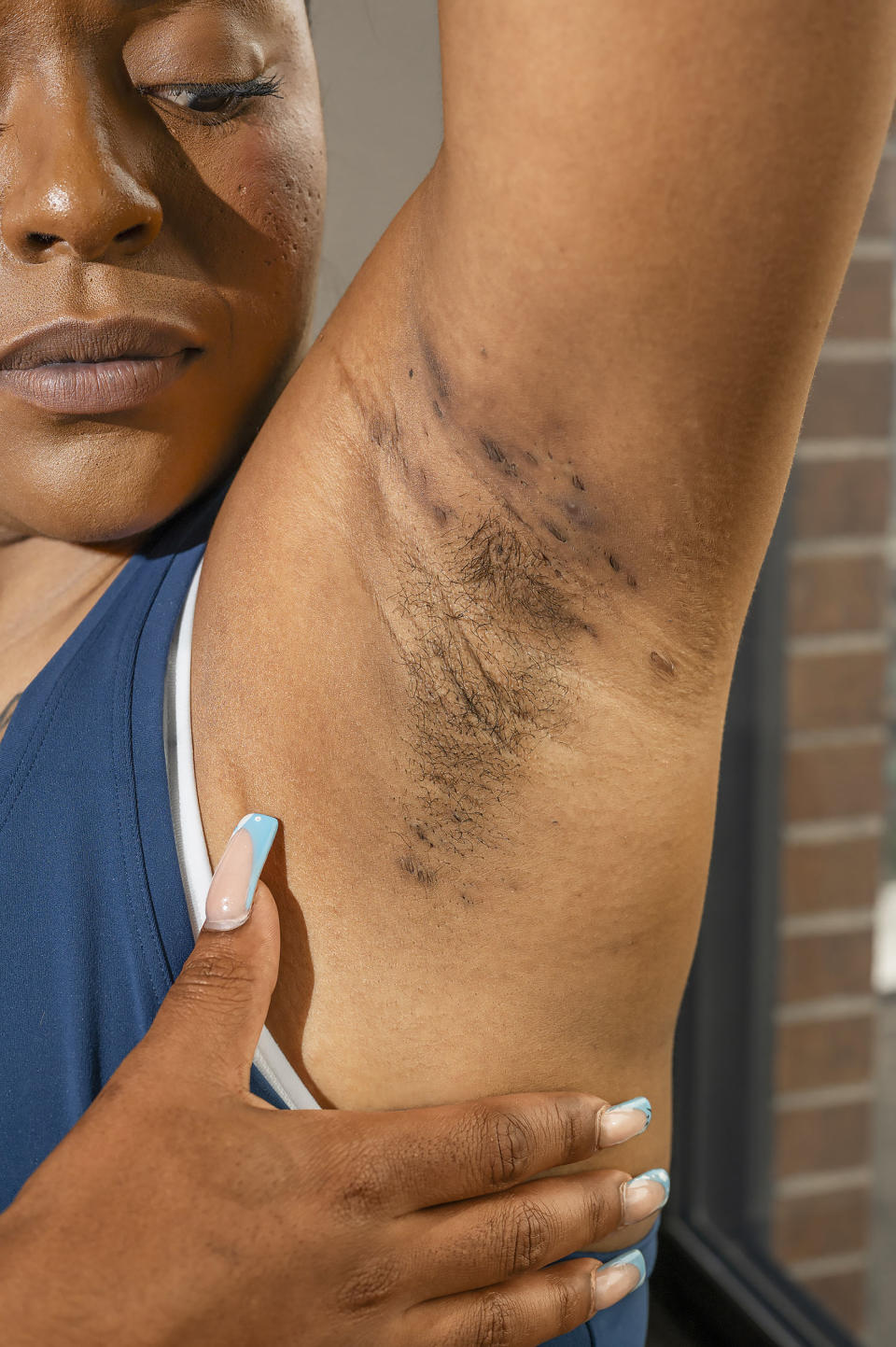 In high school, Cydney Carter felt so embarrassed of the bumps she had under her arms she advocated for long-sleeved uniforms to hide her hidradenitis suppurativa. (Courtesy UCB Make HStory)