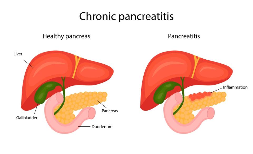 The difference between a healthy pancreas and an inflamed pancreas (Getty Images/iStockphoto)