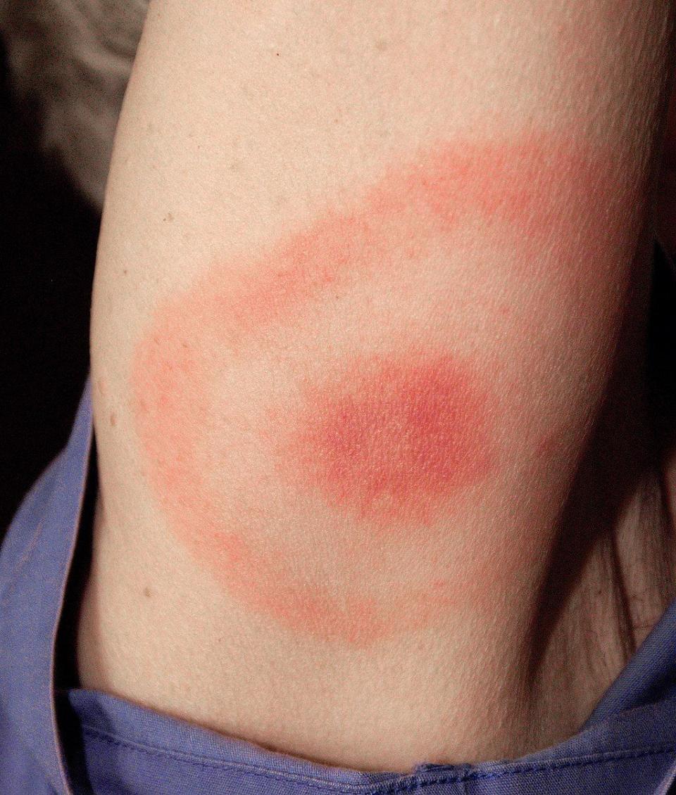 tick bite bullseye rash