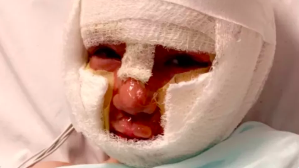 Dominick Krankall en el hospital recuper&#xe1;ndose de un peligroso incidente de quemaduras que dejaron sus peque&#xf1;os miembros y cara llenos de heridas (Go Fund Me)