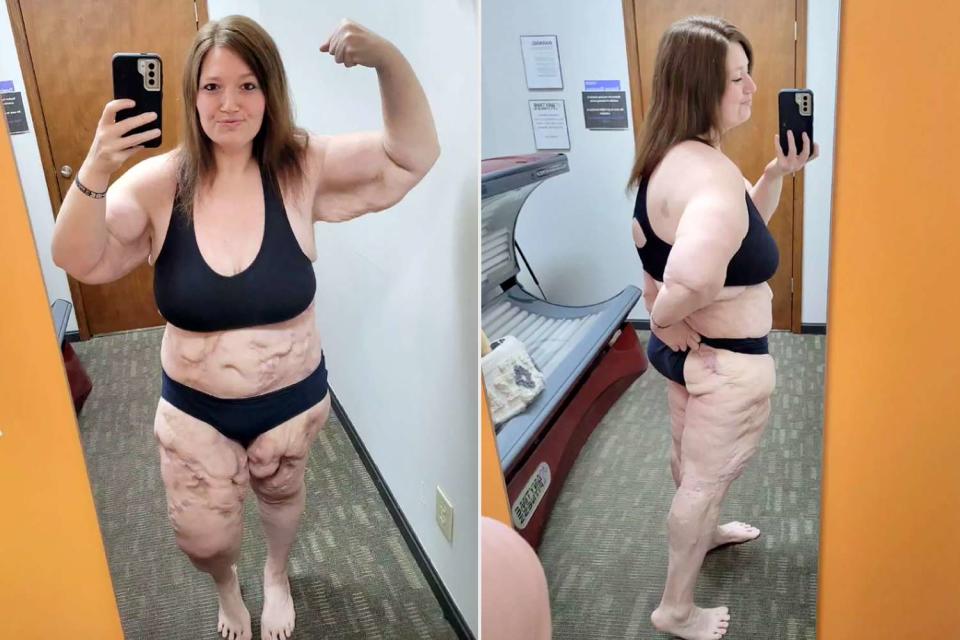 <p>Lexi Reed/Instagram</p> Lexi Reed revealing her calciphylaxis scars