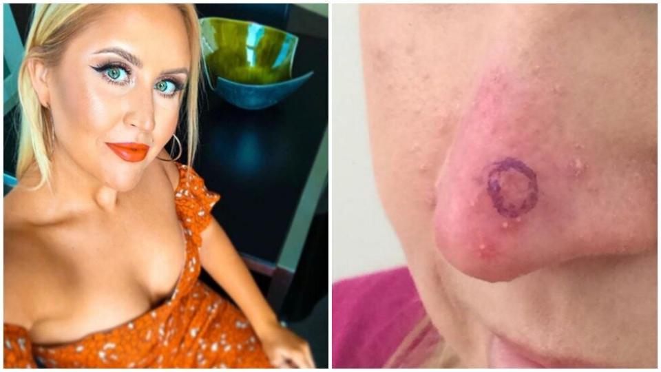 Married at First Sight star Lauren Huntriss has revealed she battled skin cancer in her 20s. Photo: Instagram