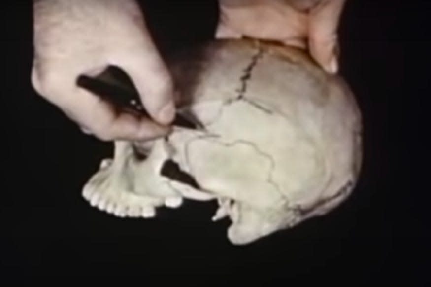 A hand pointing to the area of the skull where doctors drill a hole to perform lobotomy.