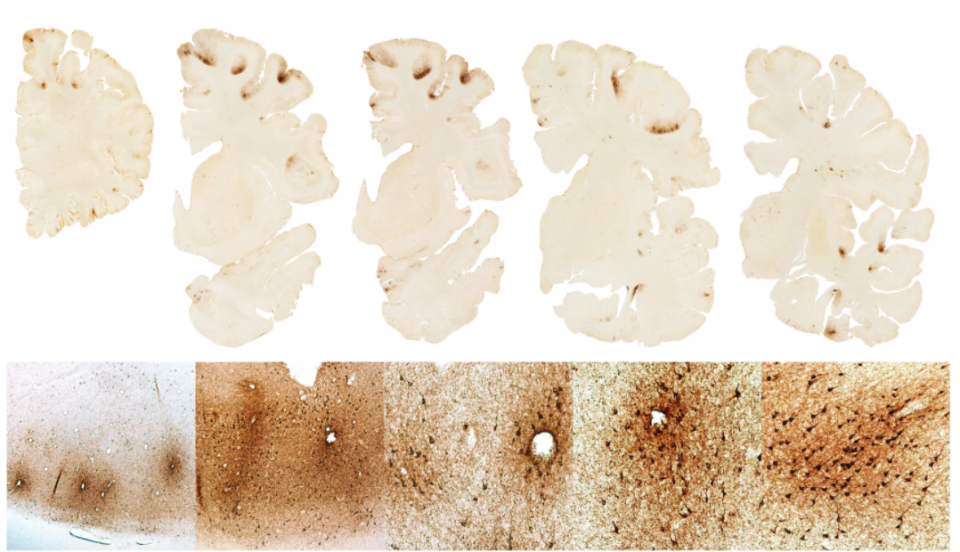 Cross-sections of the brain of Aaron Hernandez, showing areas of tau protein buildup. (BU CTE)