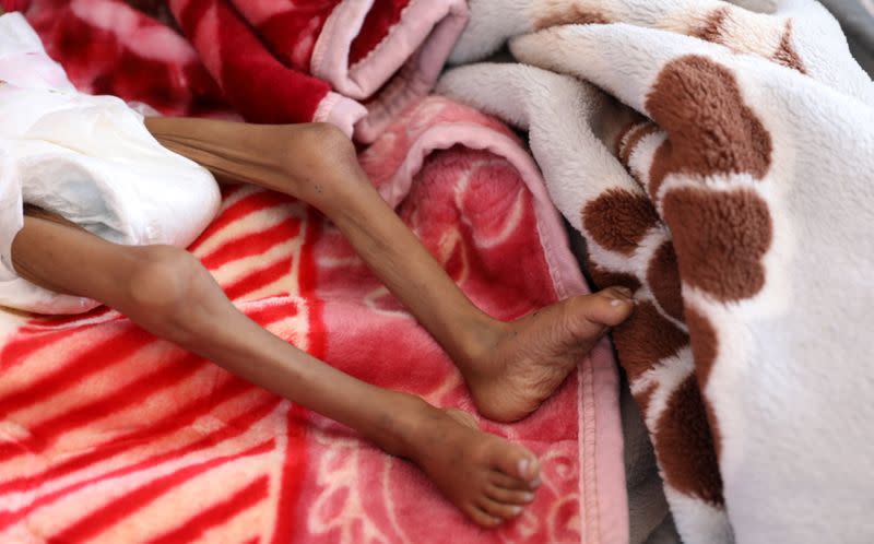 FILE PHOTO: Child malnutrition at record highs in parts of Yemen -U.N. survey