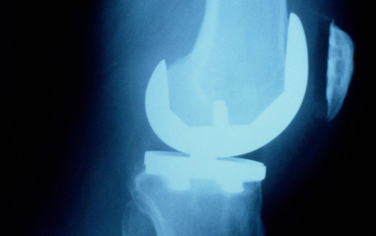 The MHRA is preparing to issue a field safety notice over a faulty knee replacement - Getty Images