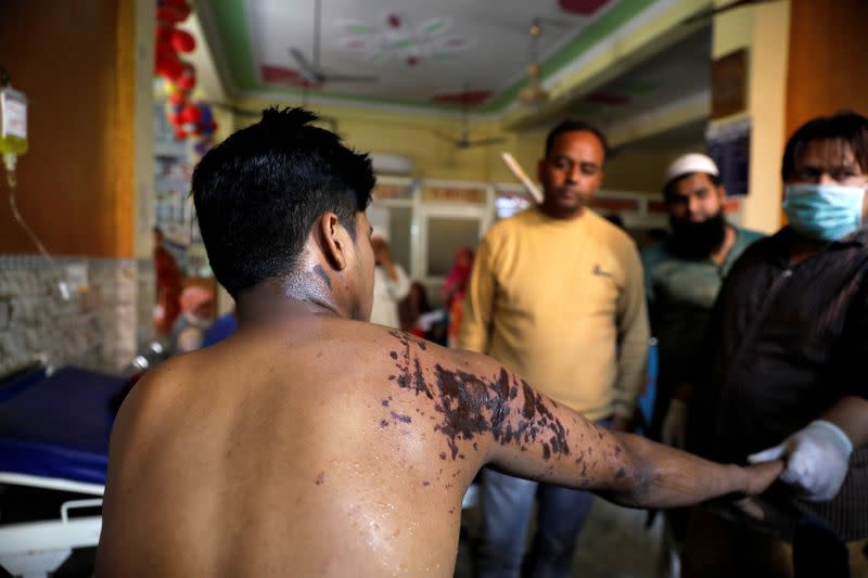 A Muslim man shows his bruises that he claimed were inflicted by acid attack during a clash between people demonstrating for and against a new citizenship law in a riot affected area, as he is being treated at Al Hind hospital in New Delhi