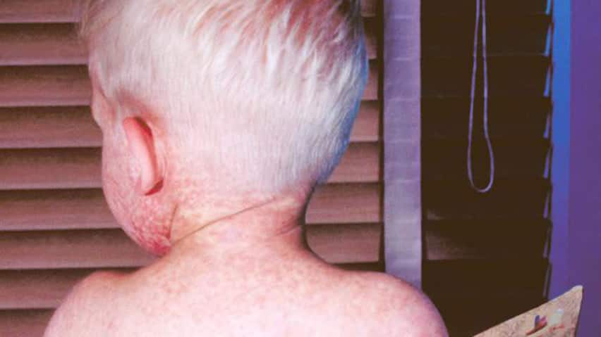 A boy with measles.