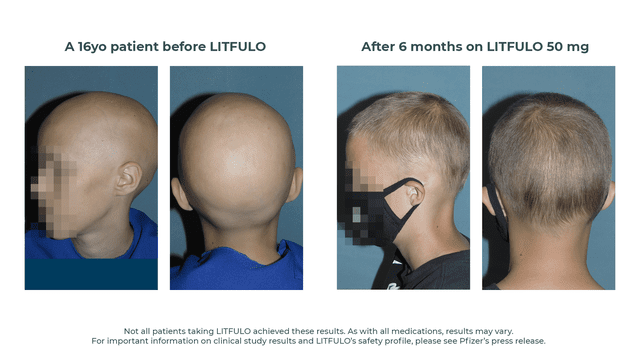 <p>Pfizer</p> 16-year-old before and after using Litfulo